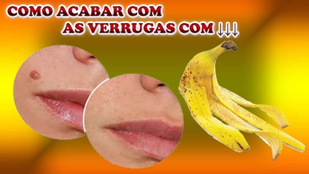 Como eliminar as verrugas com banana Como eliminar as verrugas com banana