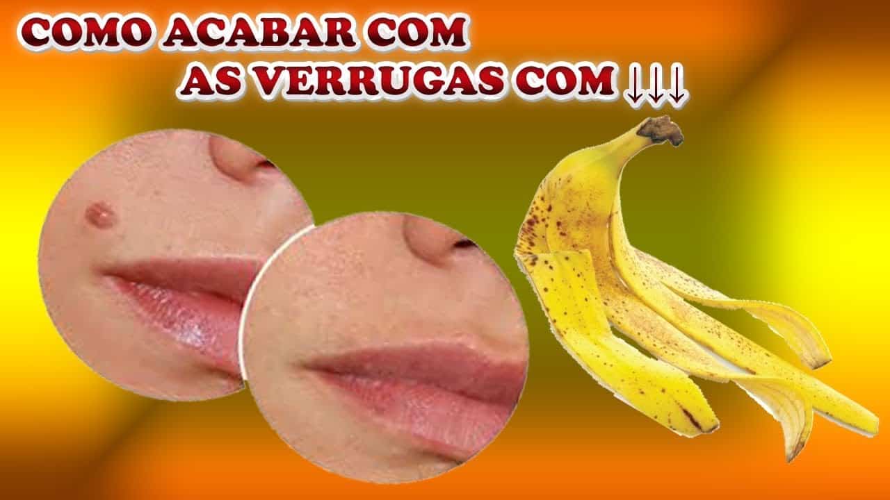 Como eliminar as verrugas com banana