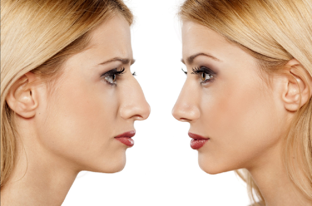 Rinoplastia corretiva para melhorar resultados ruins Rinoplastia corretiva para melhorar resultados ruins